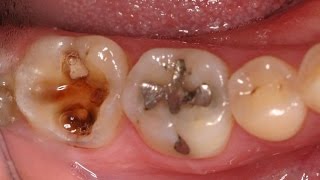 Tooth cavity | Home remedies for tooth decay and cavities