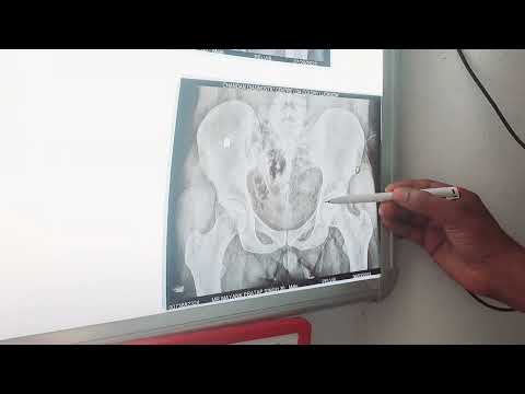 अब  💯 % Recovery होगा AVN Patients. All AVN Patients send me x-ray and MRI this no.88533 80309