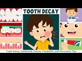 Tooth Decay Symptoms Causes Treatment And Prevention Video For Kids Learning Junction