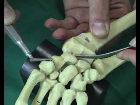 HBS (Headless bone screw) – Part 1