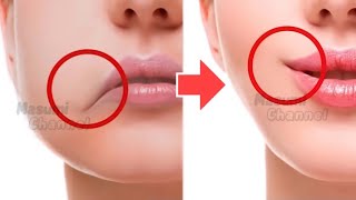 Lift Lip Corners, Fix Droopy Mouth Corners, Fat Around The Mouth, Sagging Cheeks.NO SURGERY |  NO.2
