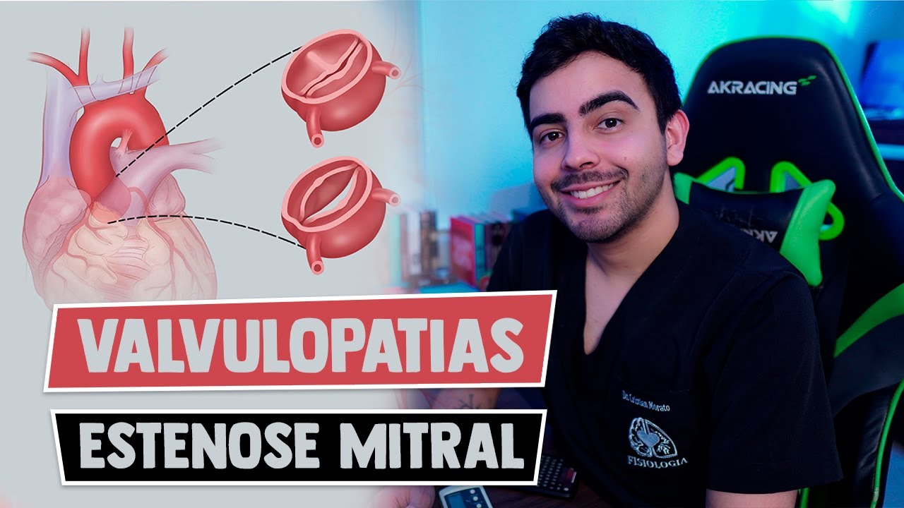 Estenose Mitral │ FISIOPATOLOGIA DAS VALVOPATIAS