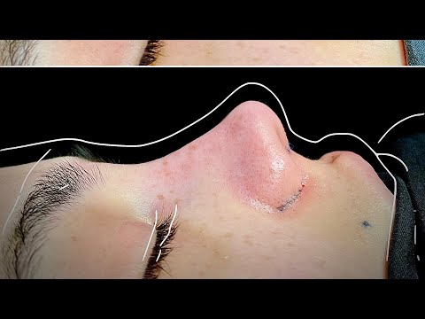 Rinoplastika — Dr. Choriyev #2