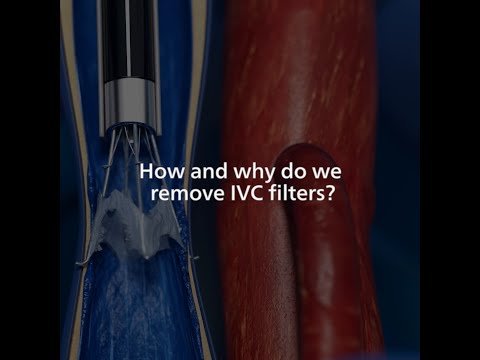 How and why do we remove IVC filters - Get in the know with Dr. Atul Gupta
