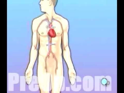PreOp® Patient Education Permanent Pacemaker Implant Heart Surgery