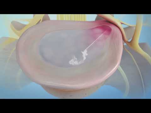 Jeff Cambra, SpinaFX - Minimally Invasive Spinal Therapies | LSI Europe '25