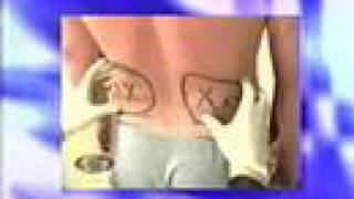 Beverly Hills Plastic Surgery News – Danny Bonaduce Gets Pure Tumescent Liposuction