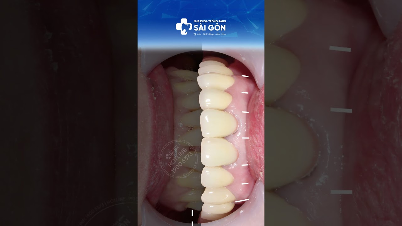 Case 17 Răng Toàn Sứ Cercon HT Loại Bỏ Khuyết Điểm Trên Răng | Nha Khoa Trồng Răng Sài Gòn