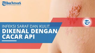 Herpes Zoster, Infeksi pada Saraf dan Kulit di Sekitarnya yang Sering Disebut dengan Cacar Api