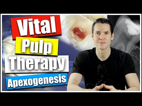 Mechanical Pulp Exposure with Vital Pulp Therapy