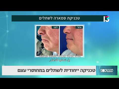 טכניקת סמארה לשתלים במחוסרי עצם