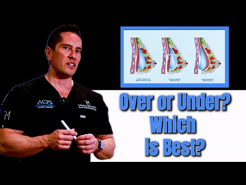 Breast Implants: Over or Under, Which is Best?