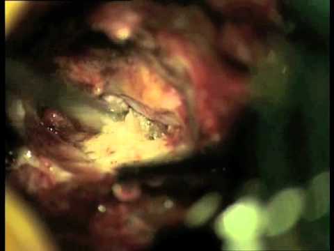 Als Gonarthrose des Knie 2 Grad zu behandeln Osteochondrose Kategorie Shelf