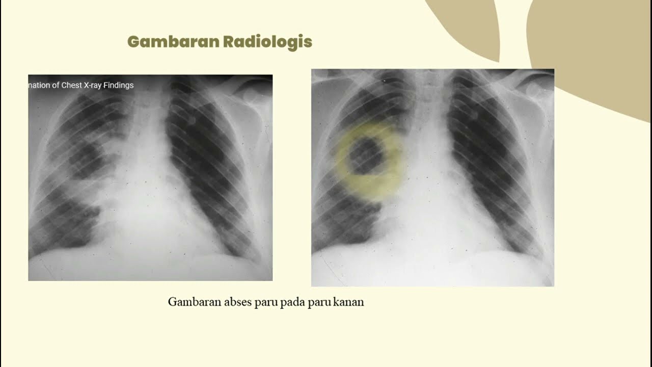 Putar video Gamabaran Radiologi ABSES PARU sekarang Gamabaran Radiologi ABSES PARU