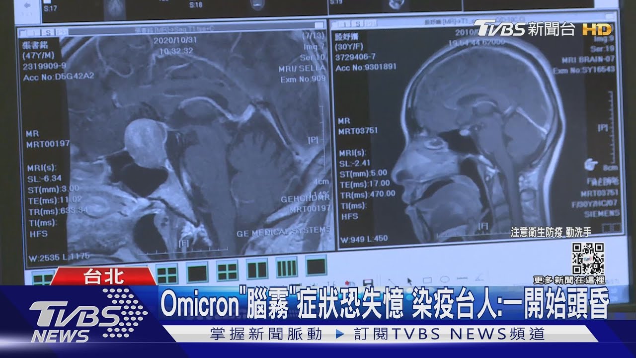 小心你的腦袋瓜!英牛津研究Omicron變種 25%患者「腦霧」