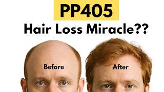 Download lagu Can PP405 Stop Hair Loss?! | New Hair Loss Medication mp3