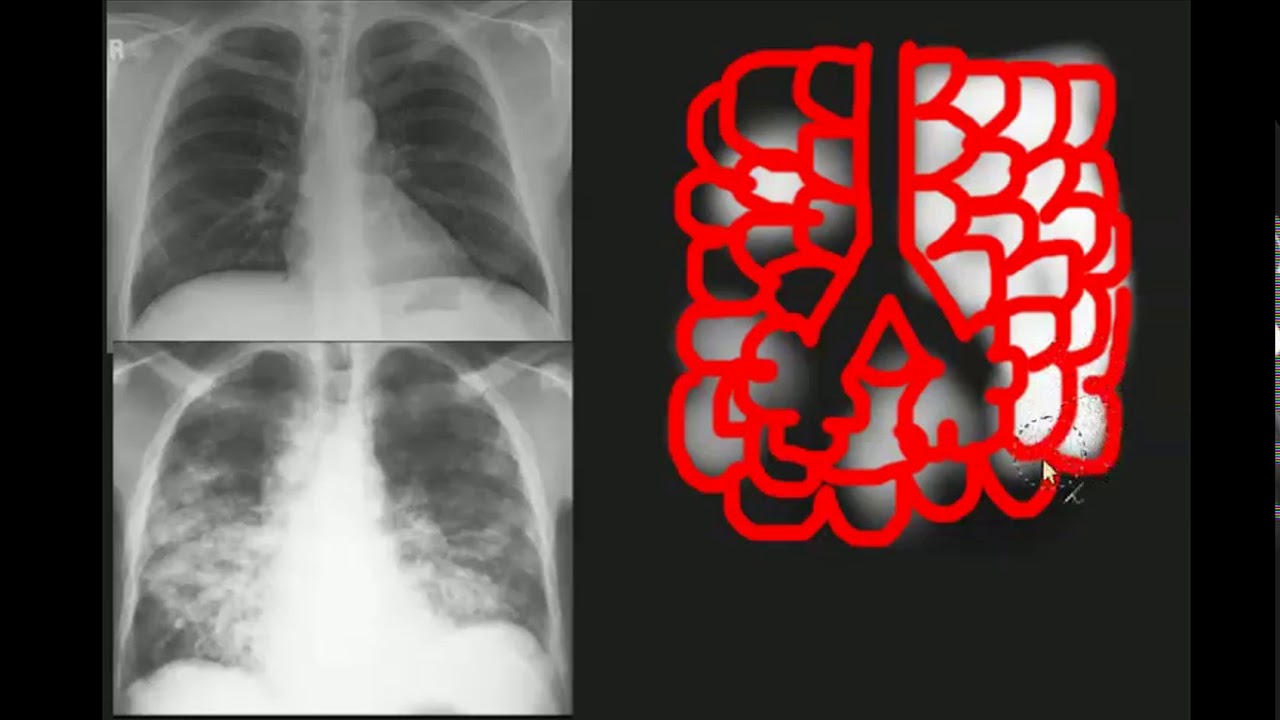 Opacidade e consolidação pulmonar