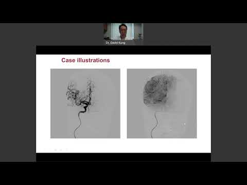 Treatments for Acute Ischemic Stroke