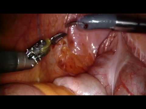RS-RARP part 1 Bowel Mobilization & Posterior Peritoneal Incision
