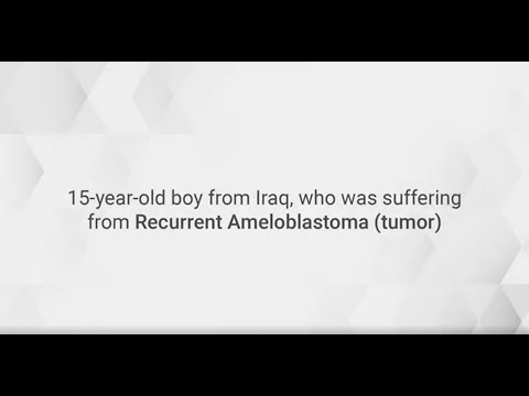 Overcoming Recurrent Ameloblastoma Through Cutting-Edge Medical Expertise