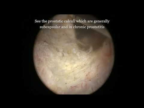 Prostatitis Vákuumszivattyú