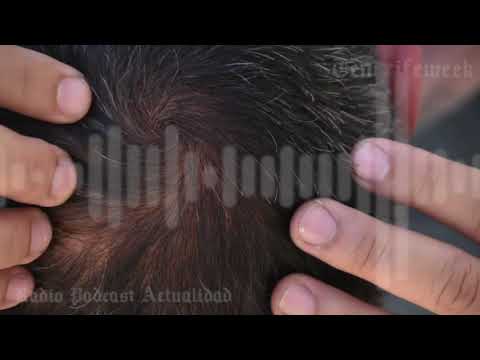 “Europa confirma que un famoso fármaco para la caída del pelo puede provocar...”, El Español