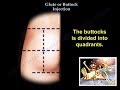 Glute Injection Everything You Need To Know Dr Nabil Ebraheim