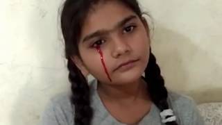 Girl crying blood tears from eyes.Rare disease.