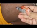Im Injection Vlog