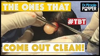 A DrPimplePopper TBT: The ones that come out clean