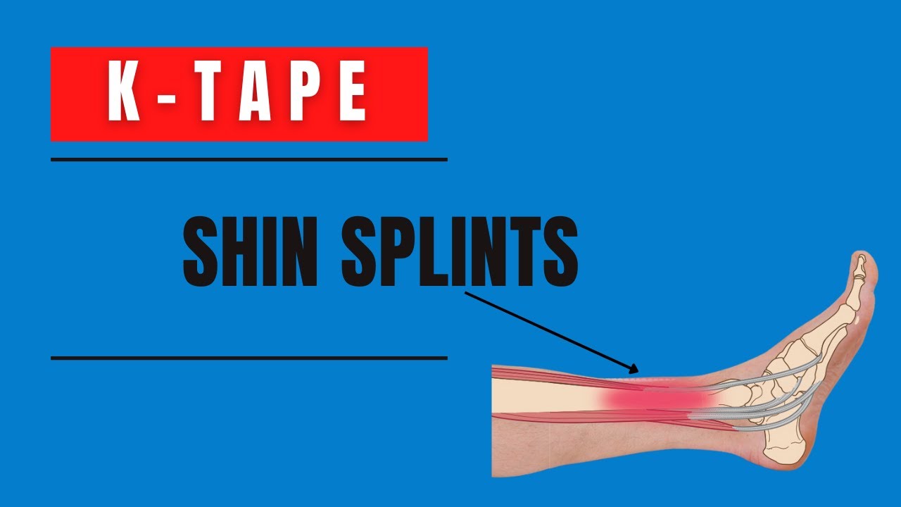 How to treat Shin Splints (Medial tibial stress Syndrome / Periostitis) with Kinesiology tape