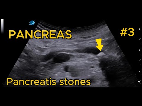 Stones in the Main Pancreatic Duct (Pancreatolithiasis) video preview