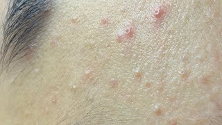 Don’t Ignore Hidden Acne for Too Long #630 P1