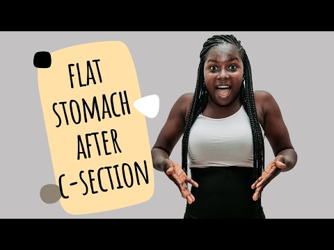 How I Lost Hanging Belly Fat After C Section | Flat Stomach After Cesarean
