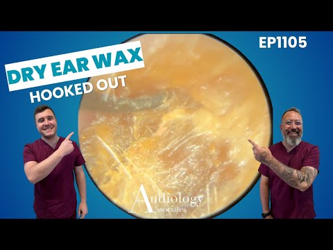 HOOKING OUT DRY EAR WAX PLUGS - EP1105