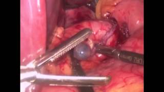 preview picture of video 'Roux-en-Y Gastric Bypass'