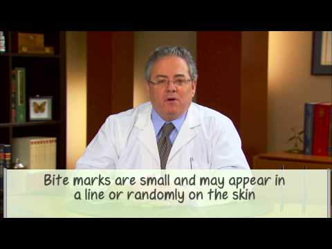 What Are the Symptoms of Bed Bug Bites? How Do I Know?