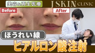 ほうれい線へのヒアルロン酸注射【施術動画】