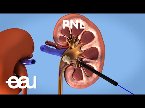 Behandlung von Nieren- und Harnleitersteinen: PNL