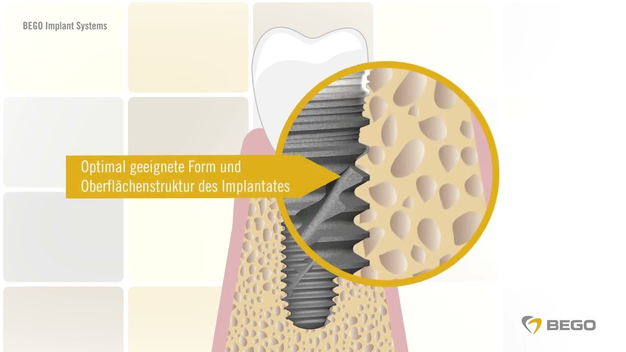 BEGO Implant Systems - animacja dla pacjentów (język niemiecki)