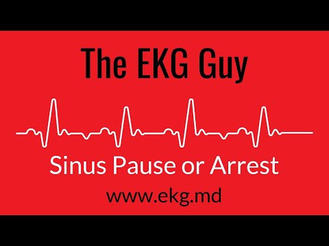 Sinus Pause or Arrest EKG l The EKG Guy - www.ekg.md