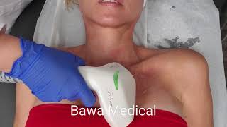 Chest Sun Damage Correction With IPL Photofacial at Bawa Medical Boca Raton