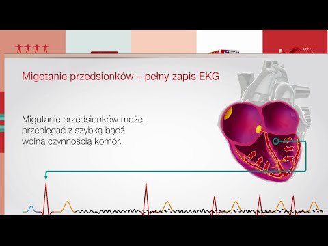 Migotanie przedsionków: część 2 - diagnoza i leczenie