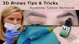 Eyebrow Tattoo Removal using Saline solution