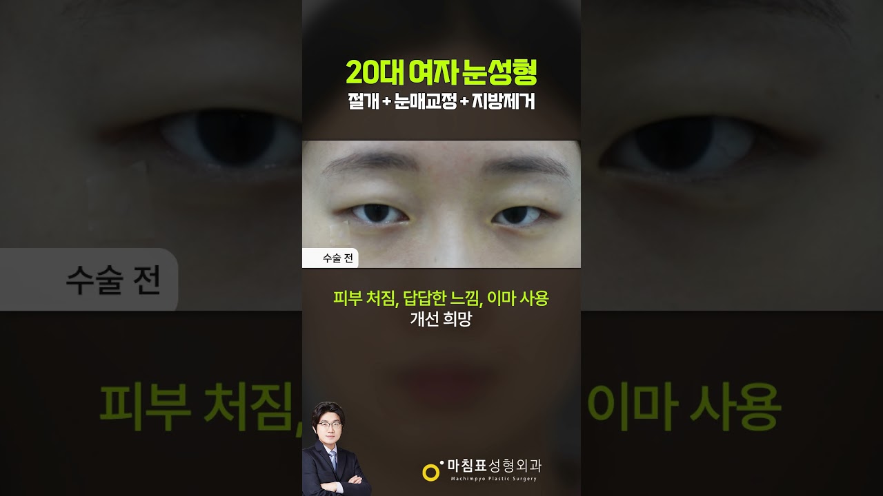 20대 여자의 답답한 눈 변화 썸네일 — 마침표성형외과 눈성형 영상