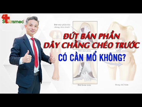 ĐỨT BÁN PHẦN DÂY CHẰNG CHÉO TRƯỚC - CÓ CẦN PHẪU THUẬT KHÔNG? | Bác sĩ Thể thao Nguyễn Trọng Thuỷ
