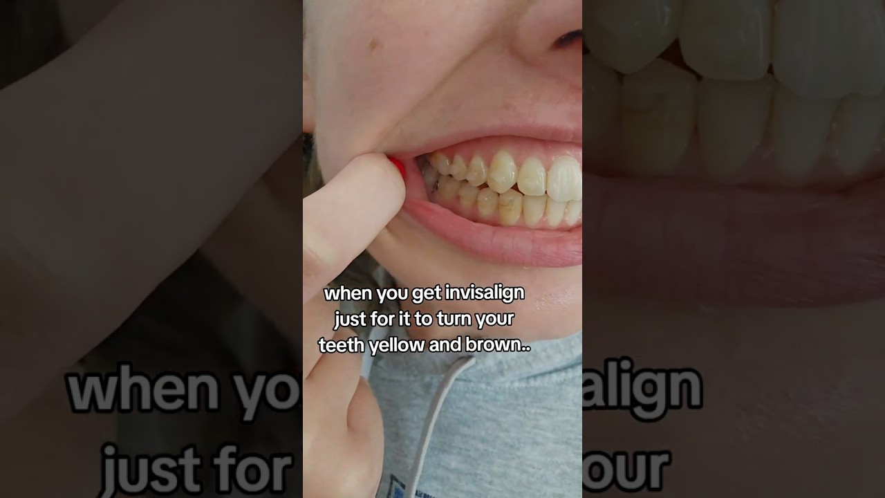 How to Prevent Stains on your Invisalign Attachments