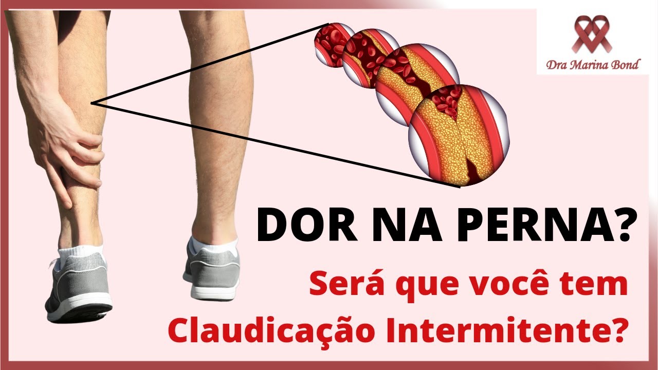 DOR nas PERNAS ao CAMINHAR (Claudicação Intermitente, Doença Arterial Periférica)