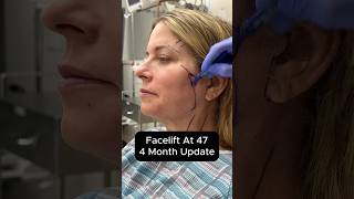 'Facelift At 47 - 4 Month Update
