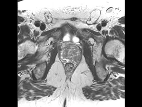 Massa eterogenea nella prostata Congestizia prostatite con calcificazioni che